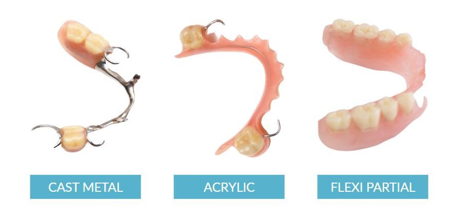 Types of partial dentures near me in Manhattan, NYC: Cast metal partial denture, acrylic or plastic partial and flexible partial denture