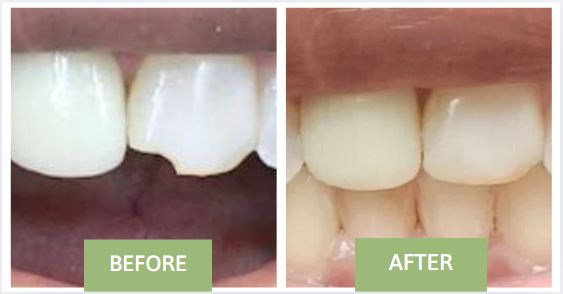before -after - chipped teeth fixed by 209 NYC emergency dentist