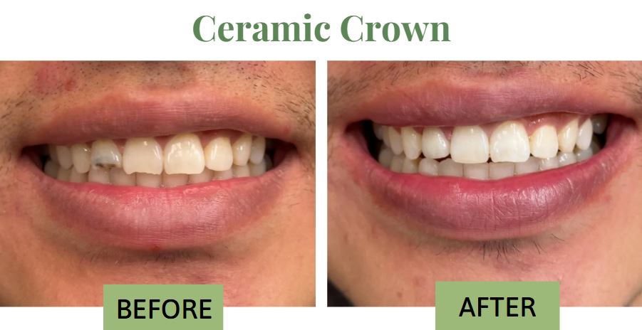 ceramic crown for broken tooth before and after by Dr Yasmika Reddy