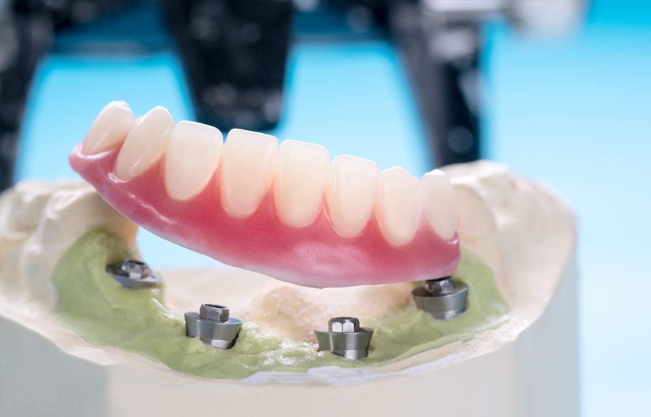 partial implant denture