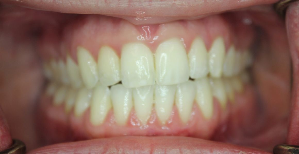 A 209 NYC Dental photo showing someone’s Invisalign results