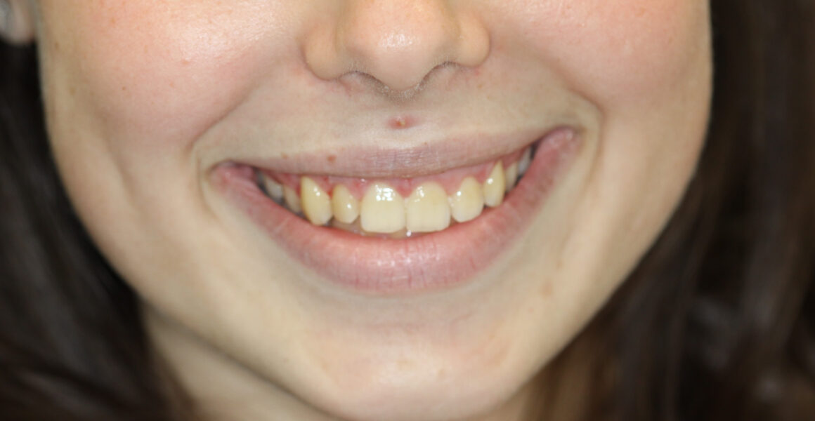 Smile Make over with gum Reshaping - Dental photos before and after - 209 NYC Dental - Dr. Jin Wang