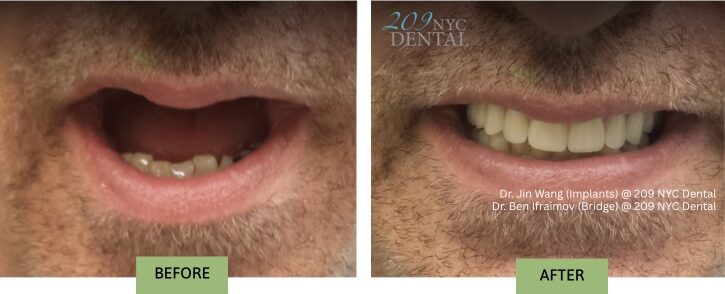 Full Arch Implant Supported Bridge