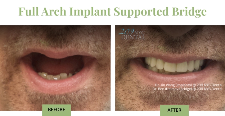 Full Arch Implant Supported Bridge