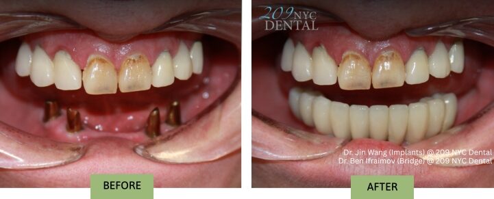 Before and after placement of a full arch lower implant supported bridge to replace missing teeth