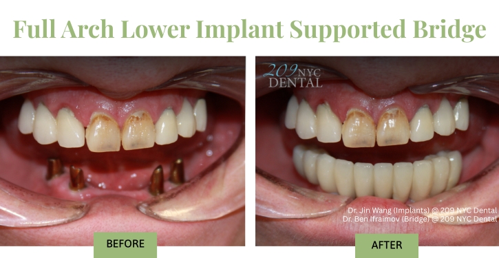 Full Arch Lower Implant Supported Bridge