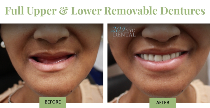 Full Upper & Lower Removable Dentures