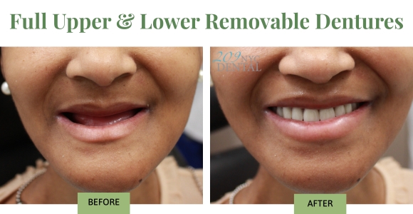Properly fitted dentures give you a natural facial profile.