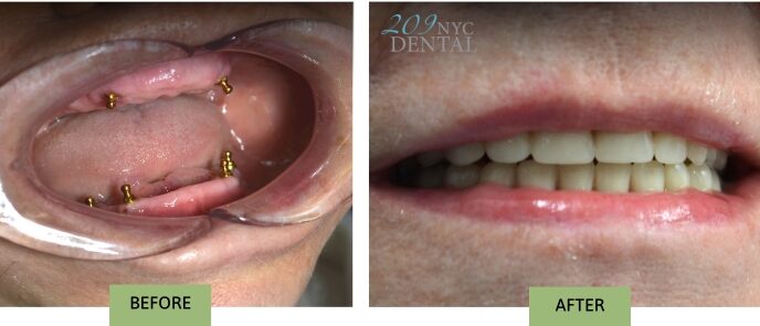 Before and after complete smile restoration using full upper and lower removable snap-in implant dentures
