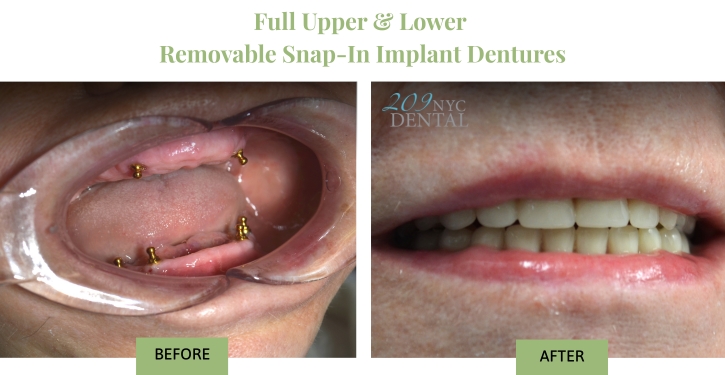 Full Upper & Lower Removable Snap-In Implant Dentures