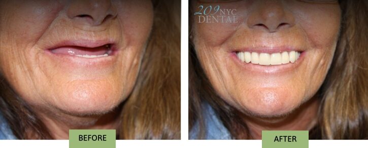 Full Upper Removable Implant Denture
