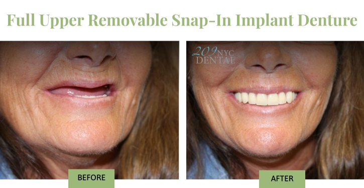 Full Upper Removable Implant Denture