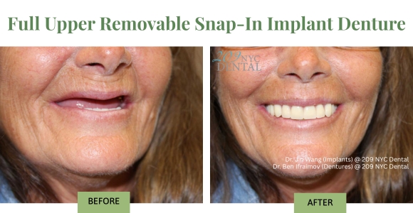 Dentures restore your facial support. They can make you look younger due to fuller cheeks. Full set of teeth is always associated with health & youth.