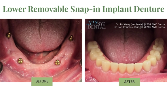 Full arch restoration - Lower Removable Snap-in Implant Denture, also known as implant overdenture, Before and After.