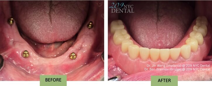 Lower Removable Snap-in Implant Denture