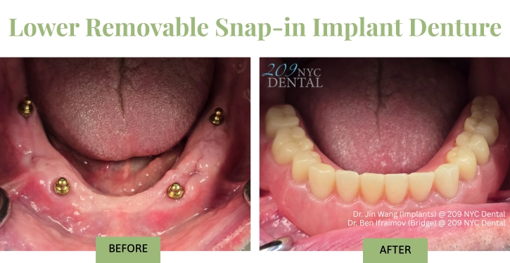 Lower Removable Snap-in Implant Denture