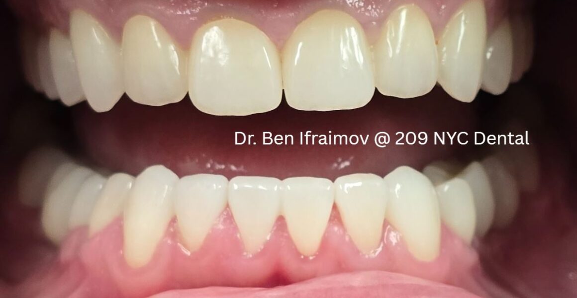 Severe teeth wear due to bruxism and grinding - Porcelain Veneers After dental photo - 209 NYC Dental - Dr. Ben Ifraimov