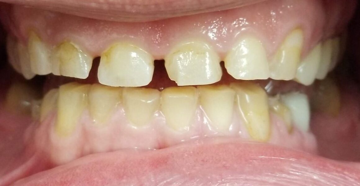 Severe teeth wear due to bruxism and grinding - Porcelain Veneers before dental photo - 209 NYC Dental - Dr. Ben Ifraimov