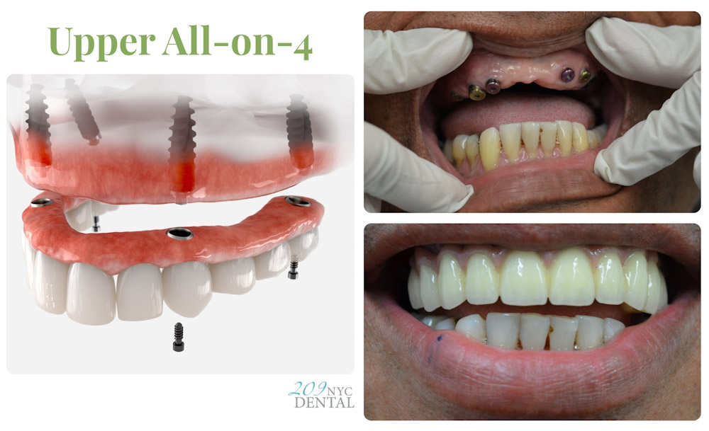 3D rendering of an upper All-on-4 dental implant system alongside real patient before-and-after photos at 209 NYC Dental in Midtown Manhattan.