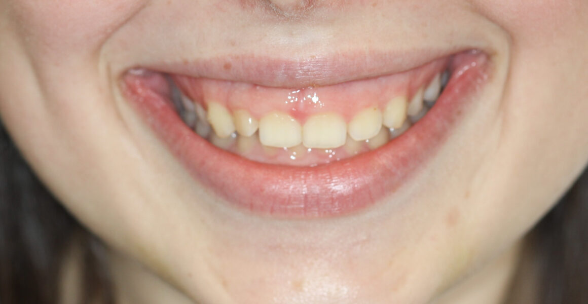 Smile Make over with gum Reshaping - Dental photos before and after - 209 NYC Dental - Dr. Jin Wang