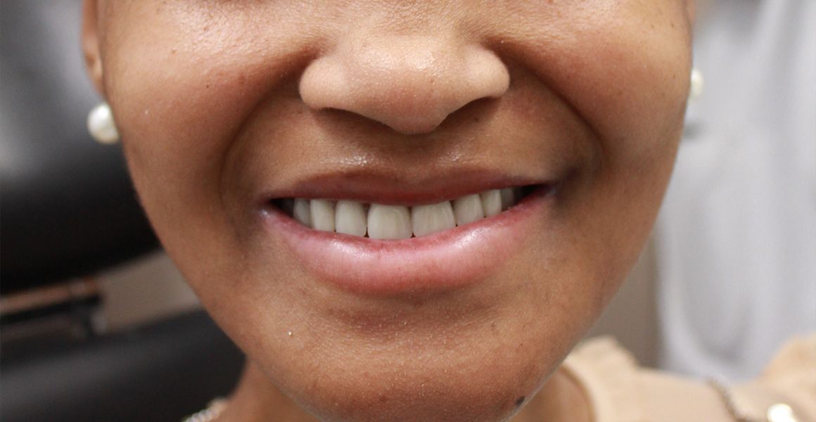A patient’s smile after a smile transformation