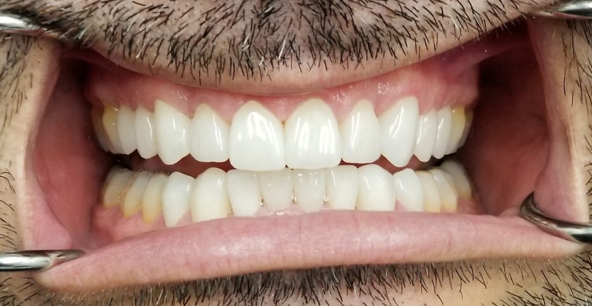 The after image from a before and after image of veneers for overbites