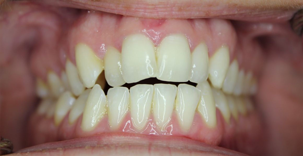 Someone’s teeth before receiving Invisalign