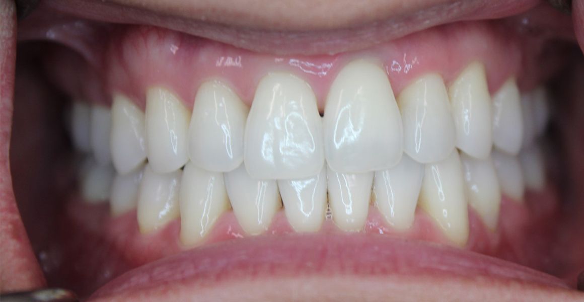 An image in a dentist’s before-and-after gallery that shows someone’s teeth after they were whitened