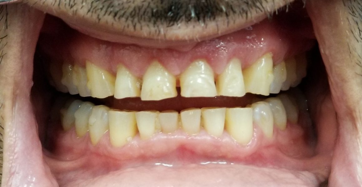 A before image of someone who needed veneers