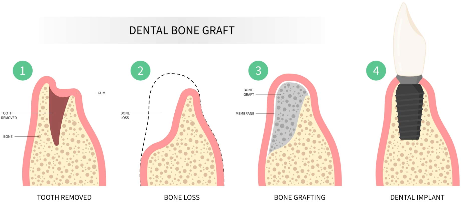 A dental bone graft illustration.