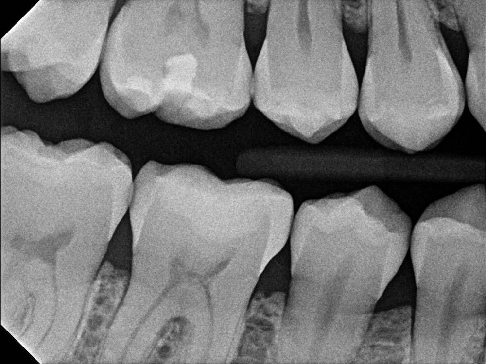 bitewing X-Ray showing molars and premolars