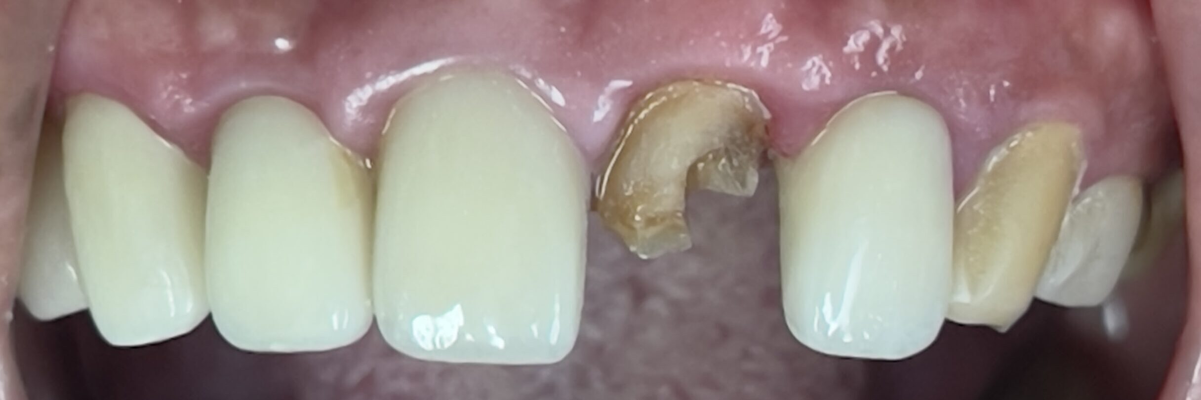 Patient traveling in New York presented to 209 NYC Dental with Dental emergency after her crown fell out.