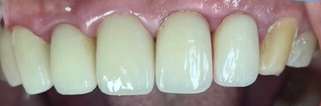 Dr. Nikitayev repaired broken tooth and recemented the crown same day. Patient was able to continue with her travels and enjoy New York City.