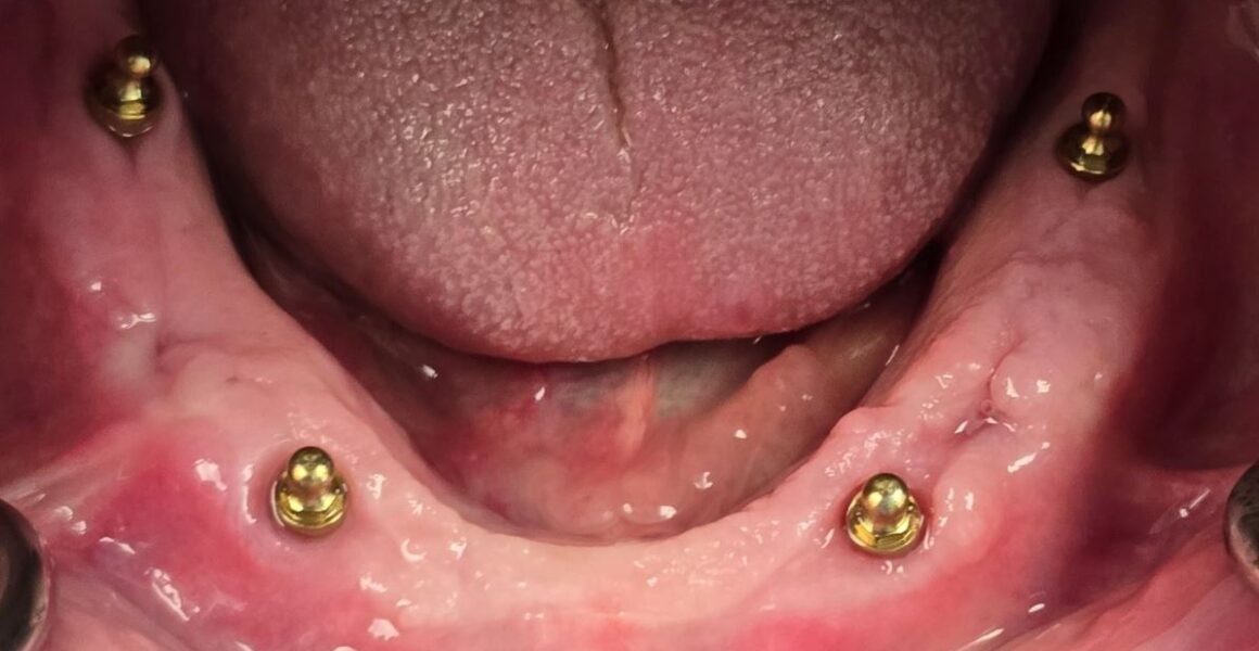 implant overdenture - 209 NYC Dental - Dr. Jin Wang - Implant placement