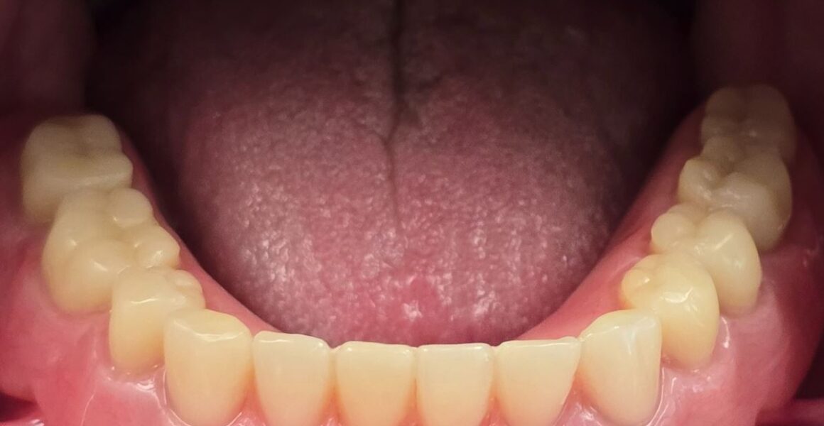 implant overdenture - 209 NYC Dental - Dr.Ben Ifraimov - After Denture Delivery
