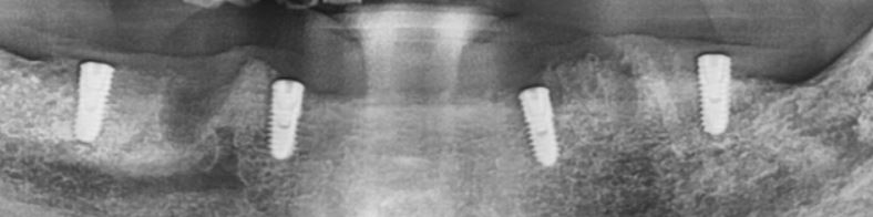 panoramic x-ray showing 4 implants placed for future implant overdenture