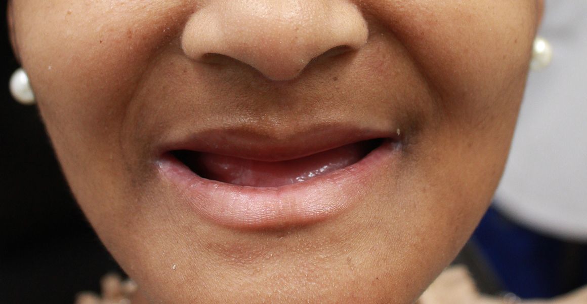 A patient before a full mouth reconstruction