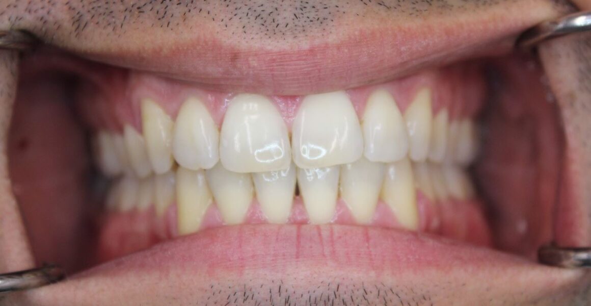 teeth whitening - 209 NYC Dental - after