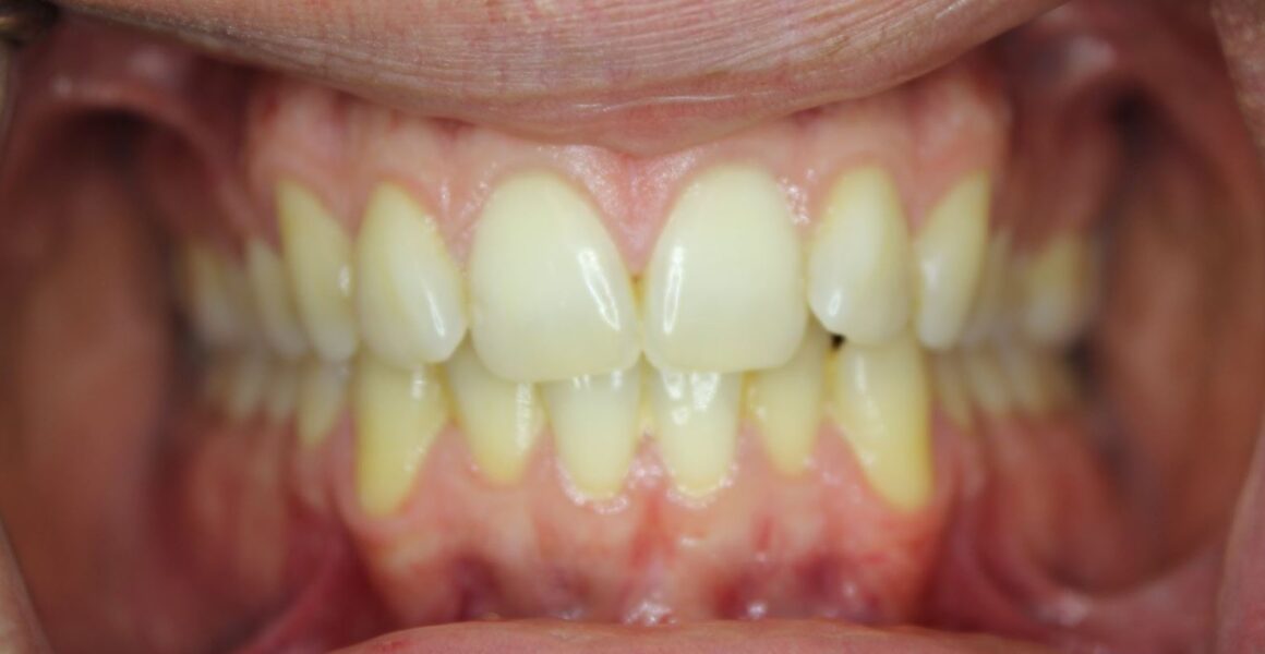 teeth whitening - 209 NYC Dental - before