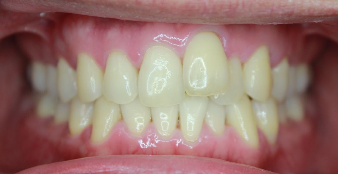 A person’s teeth before receiving teeth whitening