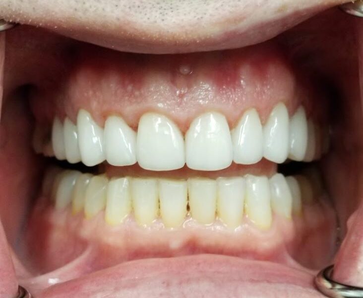 upper teeth porcelain veneers - 209 nyc Dental - Dr. Ben Ifraimov - after