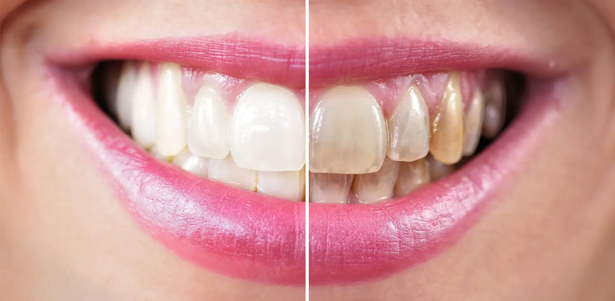 A side-by-side image showing whitened vs. discolored teeth
