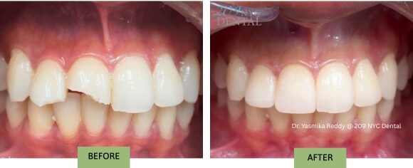 Broken Teeth Repair - Dental Bonding - Before and after picture of the dental emergency patient who fell on Saturday in NYC and boke two front teeth. Dr. Reddy repaired two broken teeth with composite bonding on Sunday in 209 NYC Dental.