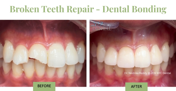 Broken Teeth Repair - Dental Bonding - Before and after picture of the dental emergency patient who fell on Saturday in NYC and boke two front teeth. Dr. Reddy repaired two broken teeth with composite bonding on Sunday in 209 NYC Dental.