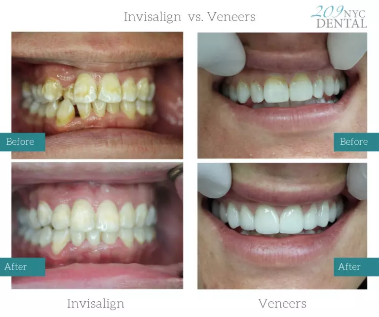 Before-and-after photos showing patients who completed Invisalign and veneer treatments
