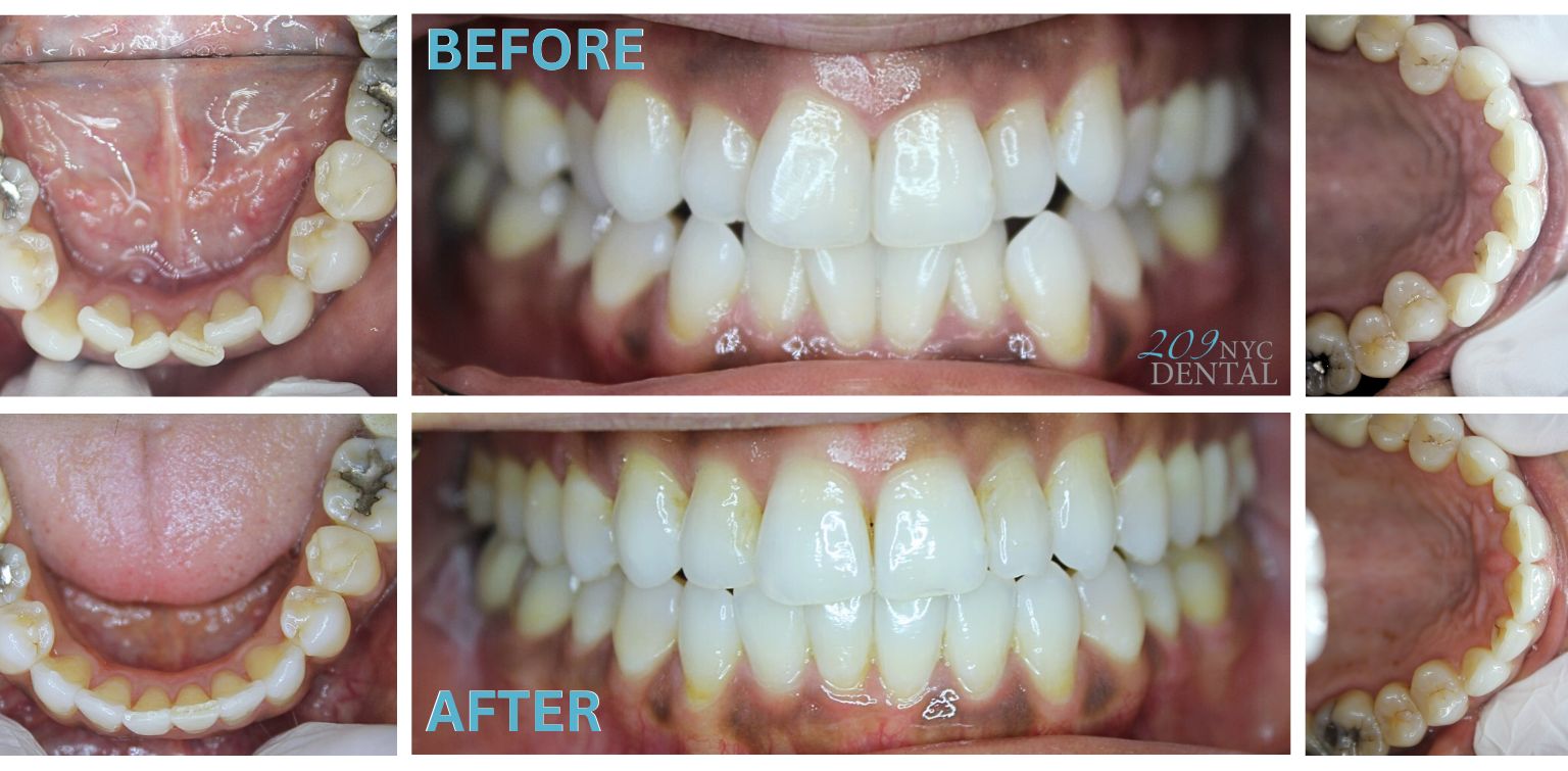 Invisalign for crowded teeth Before and after results form 209 NYC Dental