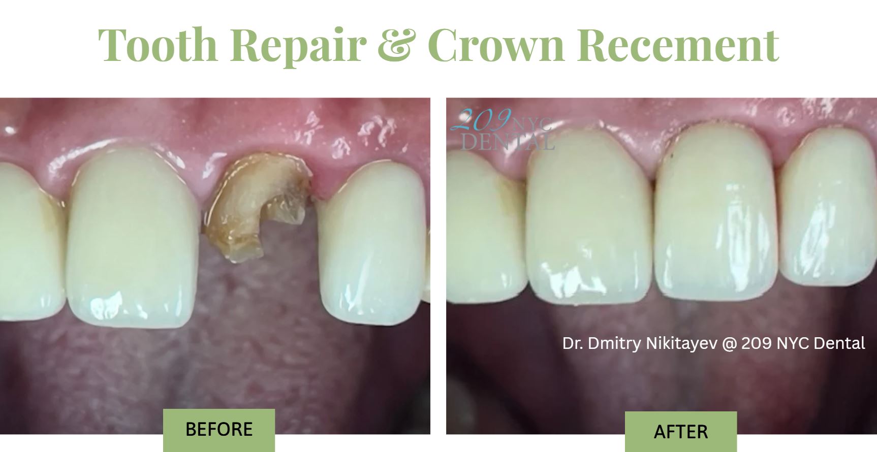 dental emergency tooth repair & crown recement before and after