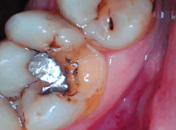 example of tooth decay
