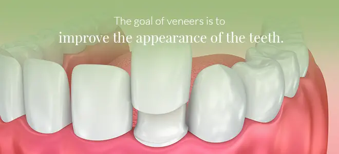A graphic showing a veneer over a tooth