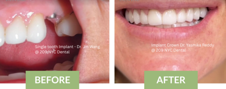 Before and after clinical comparison of a single tooth dental implant procedure at 209 NYC Dental, Manhattan. The "Before" image illustrates a missing tooth gap with a surgical dental implant post successfully integrated by Dr. Jin Wang. The "After" image displays the final aesthetic smile restoration featuring an implant-supported Zirconia crown designed and placed by Dr. Yasmika Reddy.